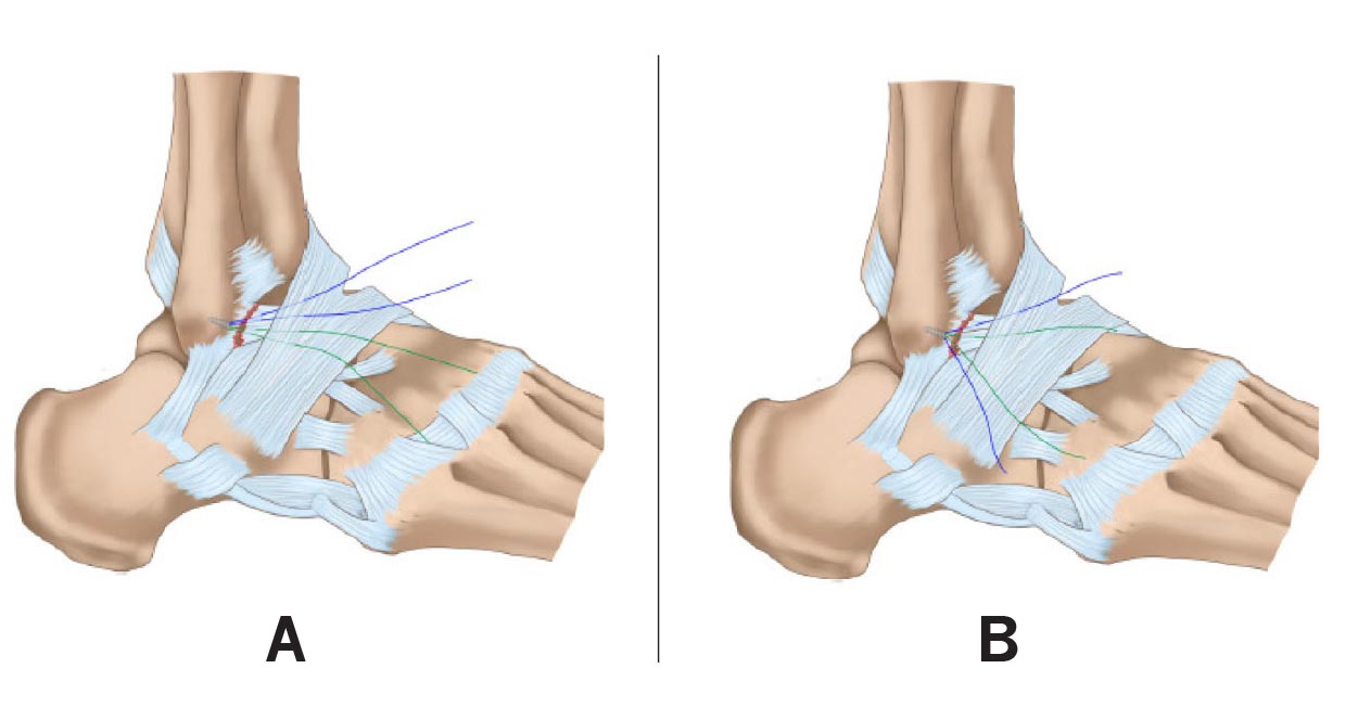 ACL Reconstruction surgery